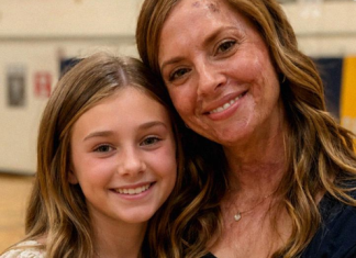 “Zbog mojih ožiljaka, ćerka me molila da ne dolazim u školu”