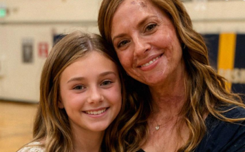 “Zbog mojih ožiljaka, ćerka me molila da ne dolazim u školu”