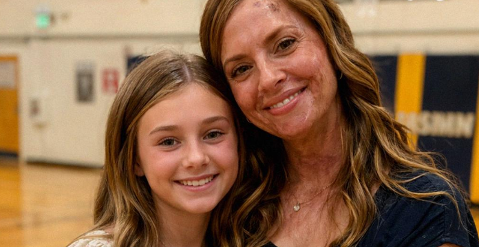 “Zbog mojih ožiljaka, ćerka me molila da ne dolazim u školu”